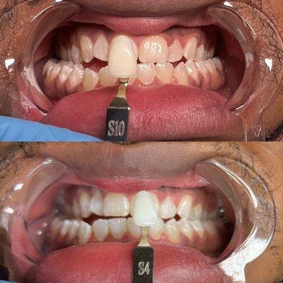 6 shades lighter in 60 min advanced teeth whitening session