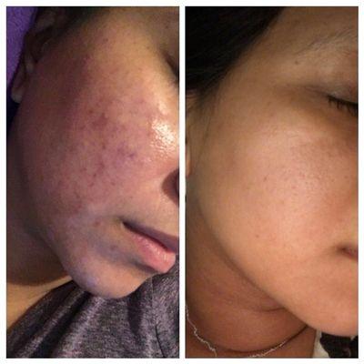 Incredible before/after result from series of facials and chemical peels.