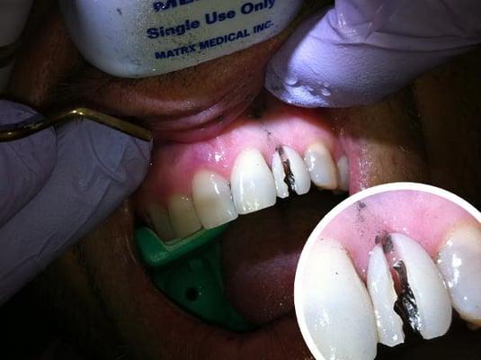 My Dental Implant Nightmare with Go Dental Valencia CA