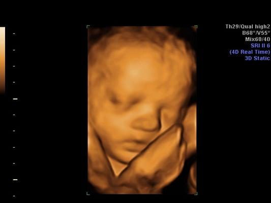 3D Ultrasound