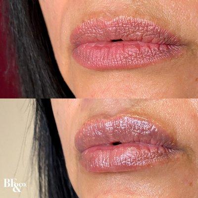 It's a great day to get lip fillers! We love the *natural* look. Injected by our Nurse Aesthetician, Liliana!