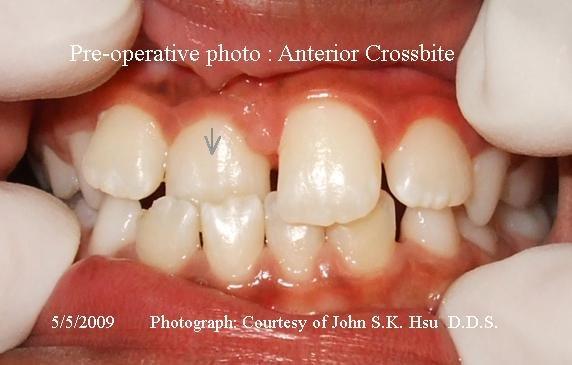 Anterior Cross bite - Before