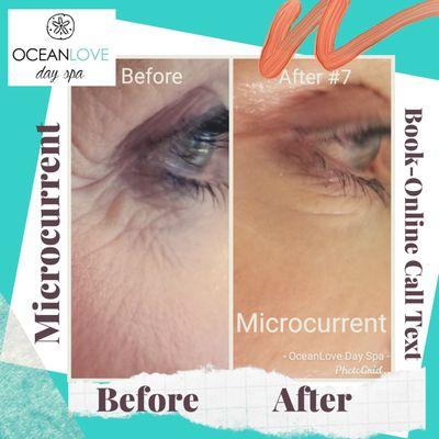 Microcurrent!  Series of 10.
1st treatment free with Before/After pics.
Call to discuss.
Heal skin, softens wrinkles.  Heals at the DNA