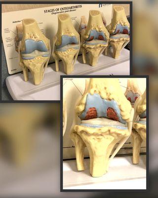 Stages of osteoarthritis. Joint looks pretty sad. Still have to wear this boot (off n on) 5 more weeks.