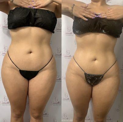 Ice Body Sculpting for Weight Loss and Body Contouring by Lucid Brows & Body