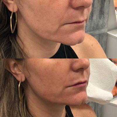 Lip filler with Juvederm Ultra XC