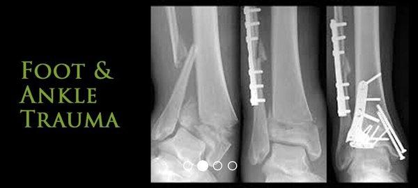 Foot and Ankle Trauma