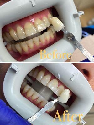 Philips Zoom whitening before and after