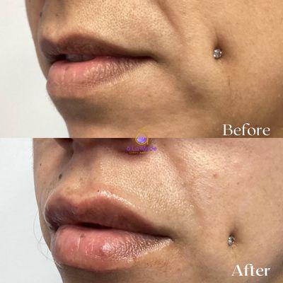 From subtle smiles to bold statements: Witness the stunning before and after of lip filler magic.