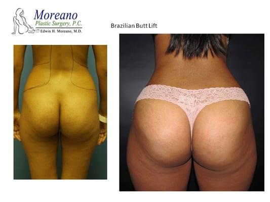 Brazillian Butt Lift performed in just one session with Dr. Moreano. We use the most advanced technology available to sculpt your body