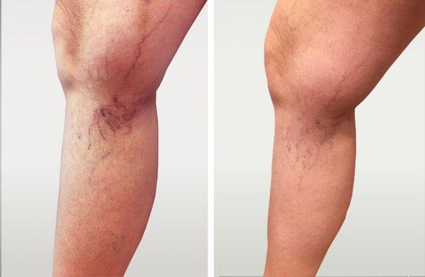 Spider vein before and after sclerotherapy 2