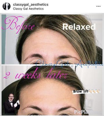 Lifted brows with Botox