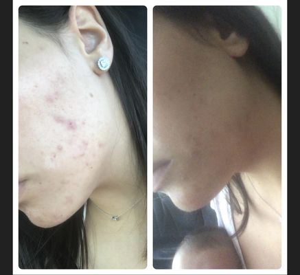 Acne treatment results within a week