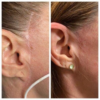 Before & After Face Lift Scar Camouflage