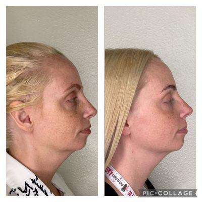 Morpheous 8 treatment before and after