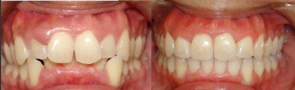 Invisalign treatment in 12months