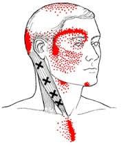 Trigger points in your neck can lead facial pain and ringing in your ears.