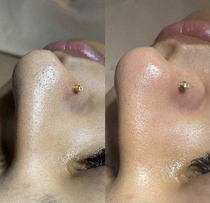 Nose Blackhead Extractions