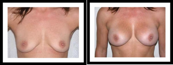 Breast Augmentation New York NY