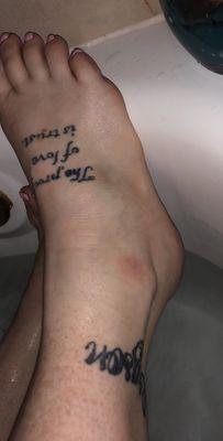 Bruising still on the outside and still swollen weeks later!