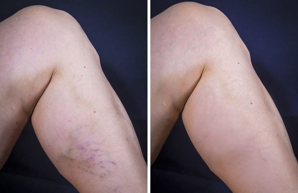 Sclerotherapy for spider veins.