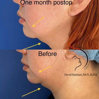 Submental fat (double chin) liposuction and radiofrequency skin tightening