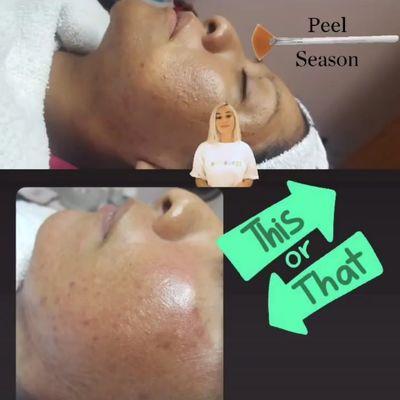 Chemical peels tailored to each individual skin needs,Before and after Results