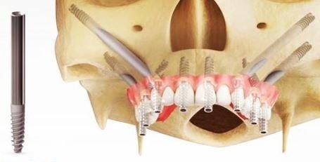 Zygomatic Implants for those with limited bone on the upper jaw.