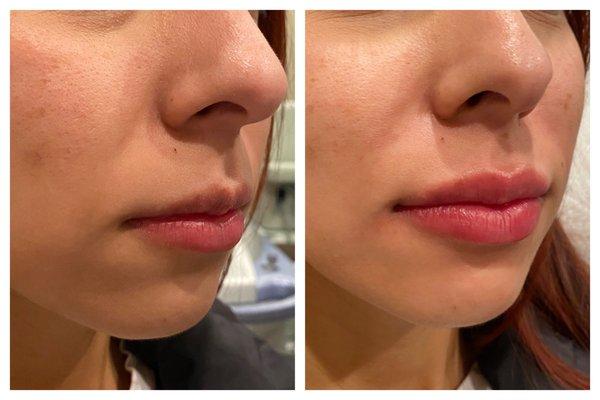 Chin and lip filler