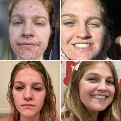 My Client from beginning to end with the Acne Facial (this is a year of progression)