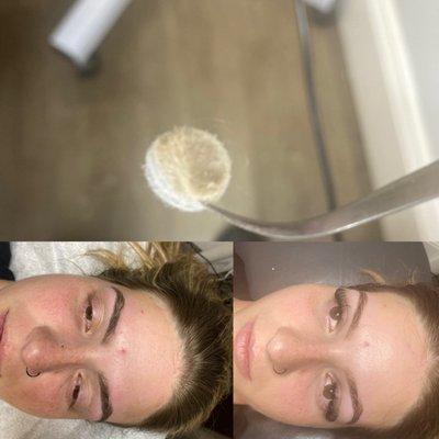 Microdermabrasion Facial Eyelash extensions