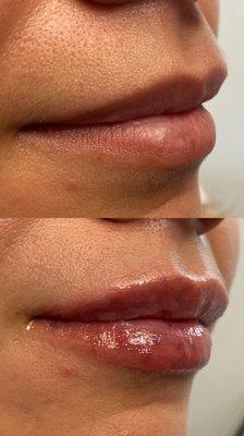 HA Lip filler (.5ml)