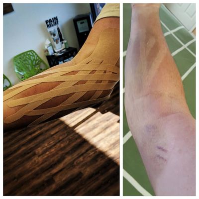 RockTape working wonders on a major bruise!