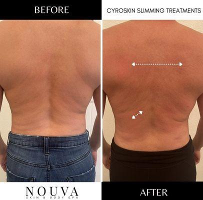 Cryoskin slimming & toning on the back