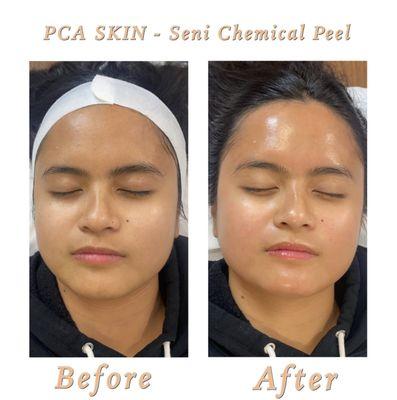 Chemical Peel: Before & After