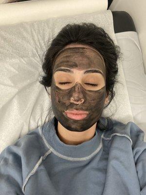 The carbon laser facial treatment