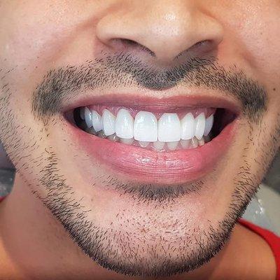 Ceramic Porcelain Veneers