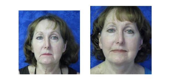 Before & after picture of our facelift procedure