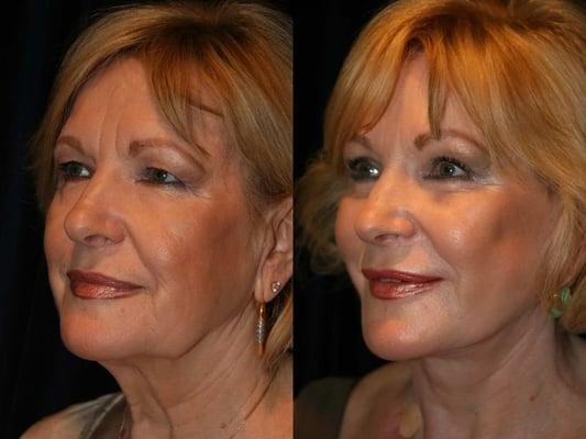 Dr. Verbin performed a facelift on this lovely woman.