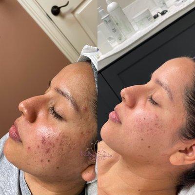 Acne free skin was our beautiful clients' #1 goal and we were able to get her exactly that