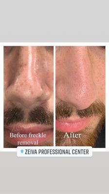 Freckles removal and sun damage was removed with laser after one treatment!!