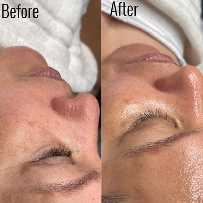 Microdermabrasion facial