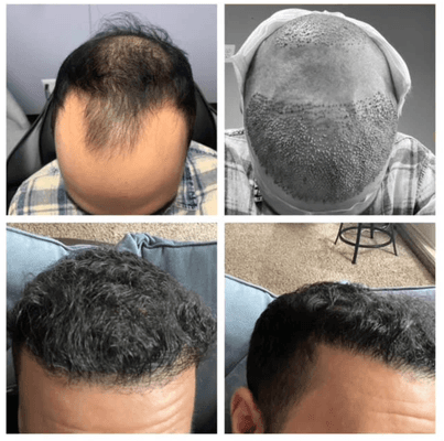 Hair Transplant
Real Clients Real Results!