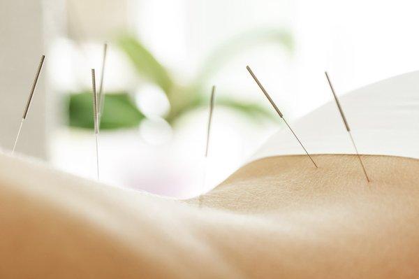 Providing Mobile Acupuncture Services for the treatment of Neck and Back pain, Headache, Anxiety, and other ailments since 1998