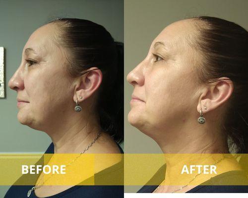 RF Skin Tightening results