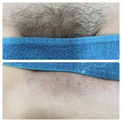 Brazilian sugaring results.  Wax isn't going to be this clean with no irritation.