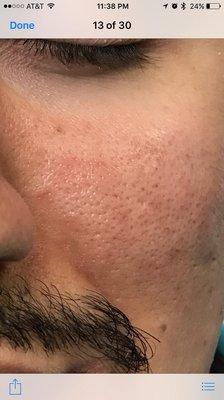 Microneedling treatment ...Minimize pores acne scars