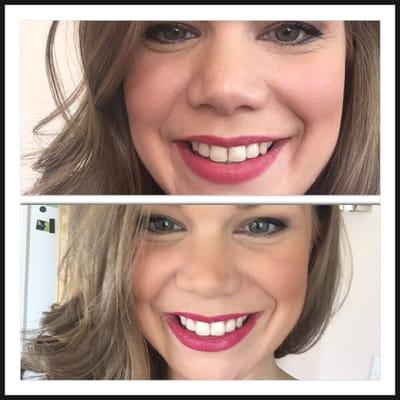 Hey beautiful before and after picture of teeth whitening treatment