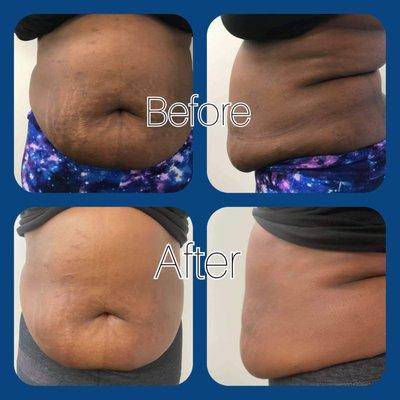 This client had three session, in office as you can see the client skin has change to look more hydrate.