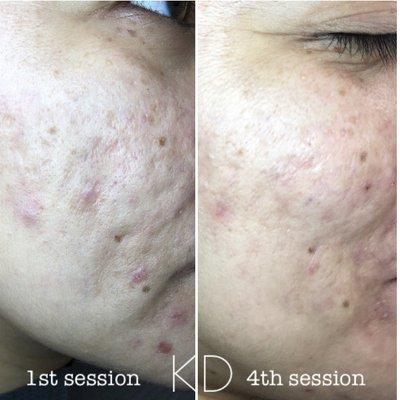 Microneedling results!  AMAZING!